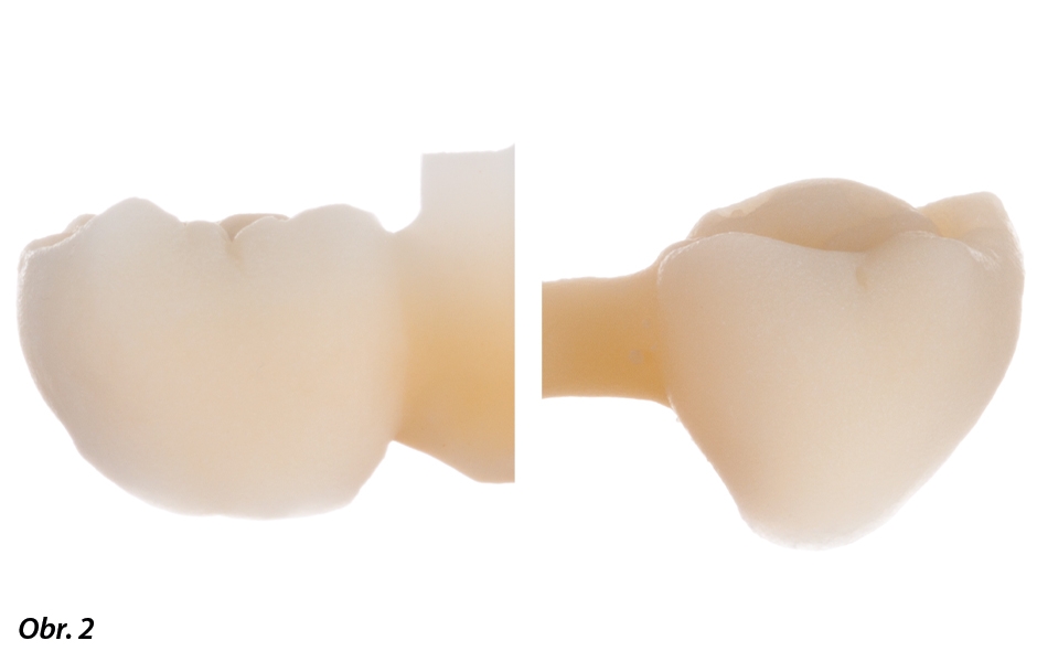 Struktura IPS e.max Press Multi podobná zubu vám umožňuje individualizovat sklovinné a dentinové části náhrady.