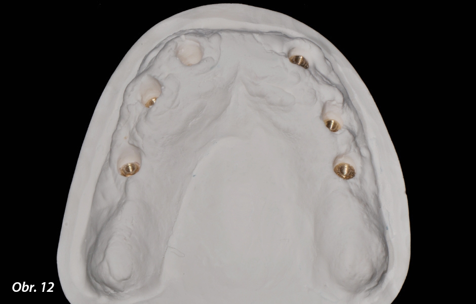 Po vhojení implantátů následovaly otisky a výroba pracovních modelů