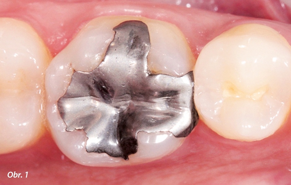 Situace před ošetřením: defektní amalgámová výplň v zubu 36