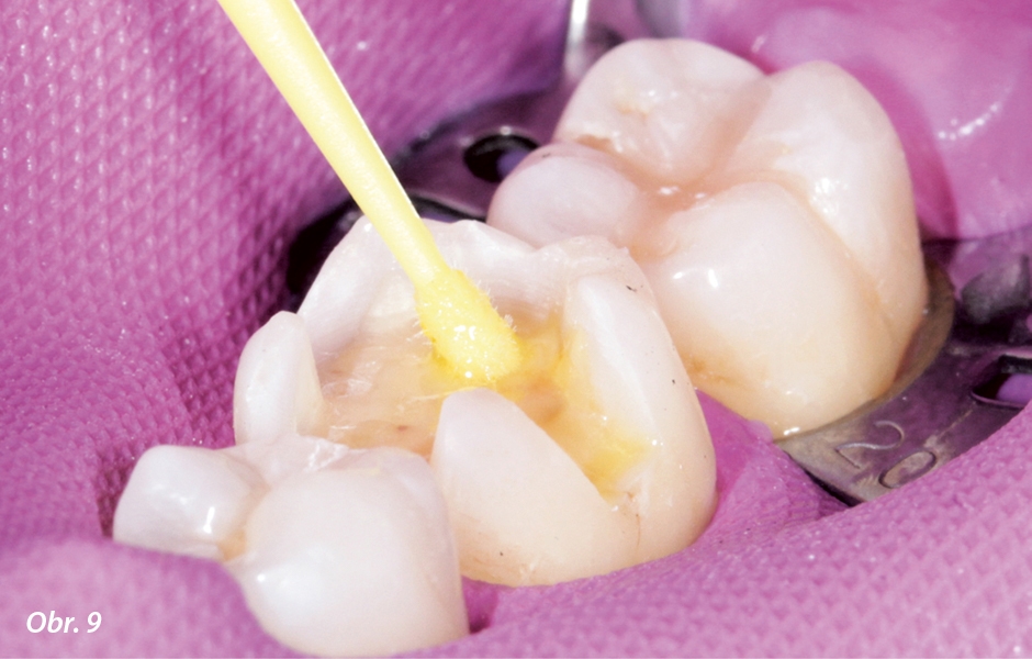 Kondicionování preparovaného zubu Adhese® Universal po dobu 20 s – následovalo osušení vzduchem