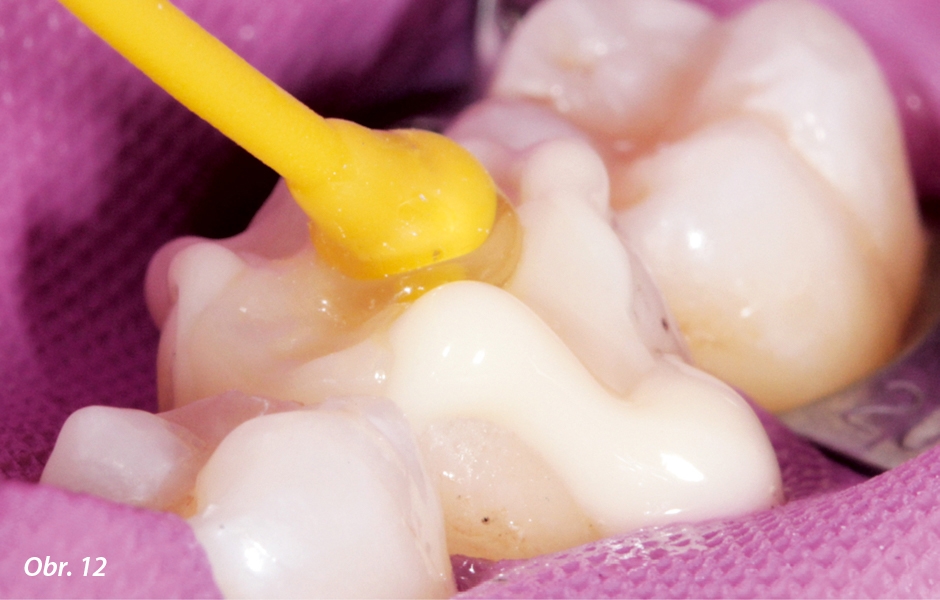 Nasazování a umisťování inleje na zub: následovalo odstranění přebytku materiálu