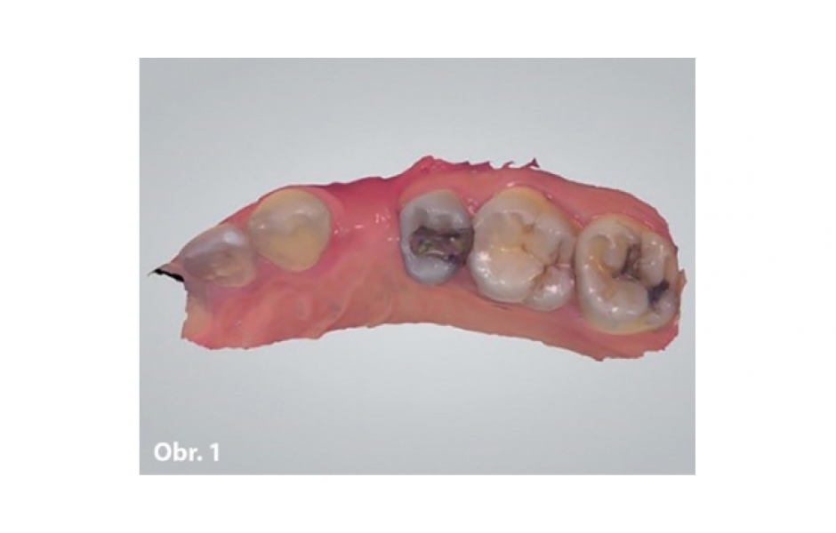 Sólo implantát: Náhrada horního premoláru pomocí digitálního pracovního postupu