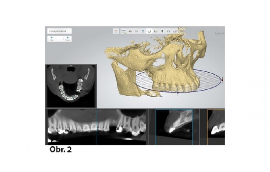 Sólo implantát: Náhrada horního premoláru pomocí digitálního pracovního postupu