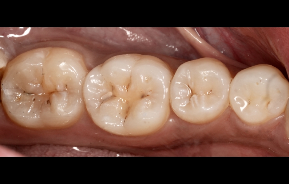 Obr. 1a: Předoperační klinická situace. Primární kaz na okluzních plochách zubů 36 a 37.