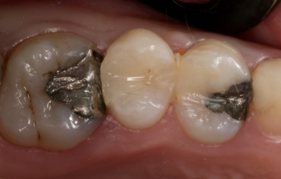 Obr. 2a: Nevyhovující amalgámová výplň na zubu 16 s klinickými známkami možného sekundárního kazu.