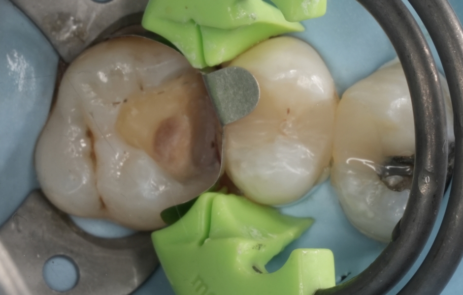 Obr. 2b: Izolace kofferdamem, odstranění amalgámu a úprava sklovino-dentinového rozhraní kombinací tvrdokovových fréz a air-abraze (Al₂O₃ 29 μm, 3 bar). Zavedení sekční matrice pro rekonstrukci kontaktního bodu.
