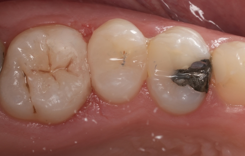 Obr. 2c: Bezprostřední pooperační výsledek rekonstrukce zubu 16 (GrandioSO Unlimited, cluster A3) s charakterizací FinalTouch brown/white.