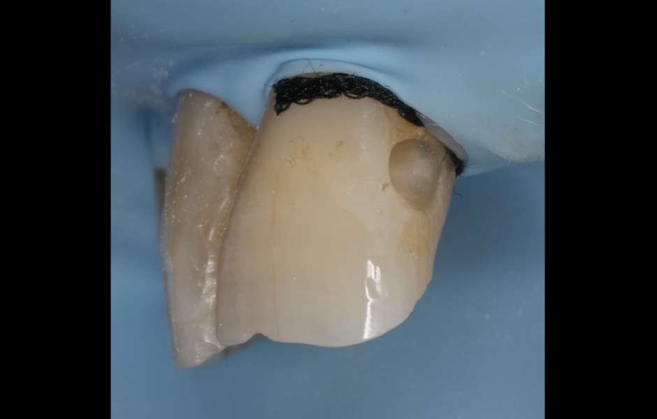 Obr. 3b: Izolace kofferdamem, úprava sklovino-dentinového přechodu kombinací tvrdokovových fréz a air-abraze (Al₂O₃ 29 μm, 3 bar). Zavedení retrakčního vlákna impregnovaného adstringentem pro hemostázu a retrakci gingivy.