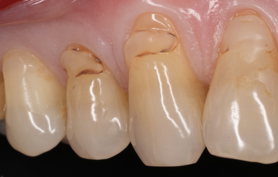 Obr. 4a: Předoperační stav výplní 13 a 14.