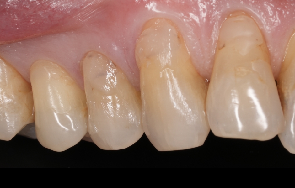 Obr. 4b: Izolace OptraGate a předoperační posouzení odstínu GrandioSO Unlimited A3.5 v nevytvrzeném stavu.