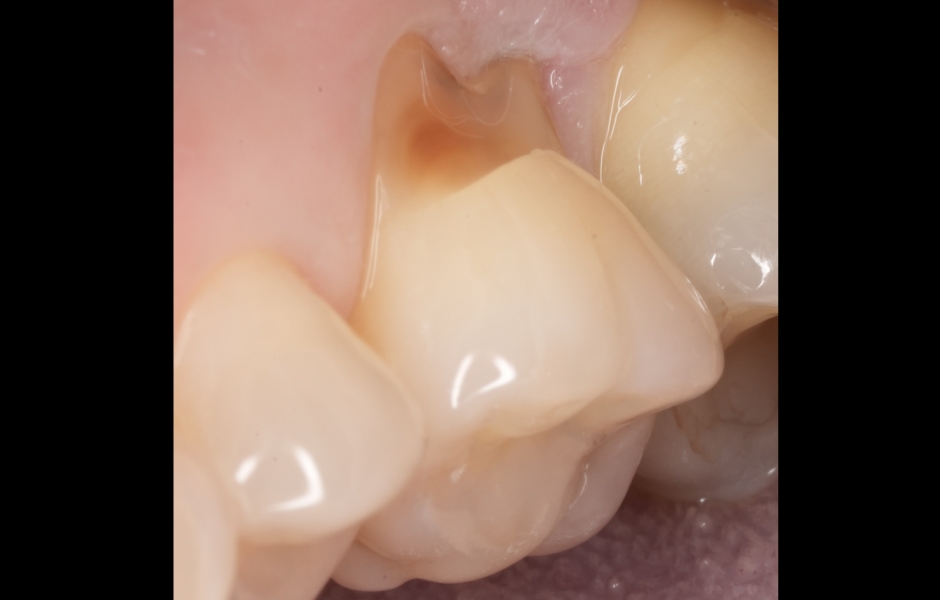 Obr. 5a: Předoperační stav zubu 26 (frontální pohled).