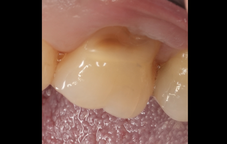 Obr. 5b: Předoperační stav zubu 26 (bukální pohled).