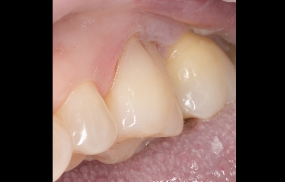 Obr. 5c: Hotová výplň na zubu 26 (cluster A3) – frontální pohled.