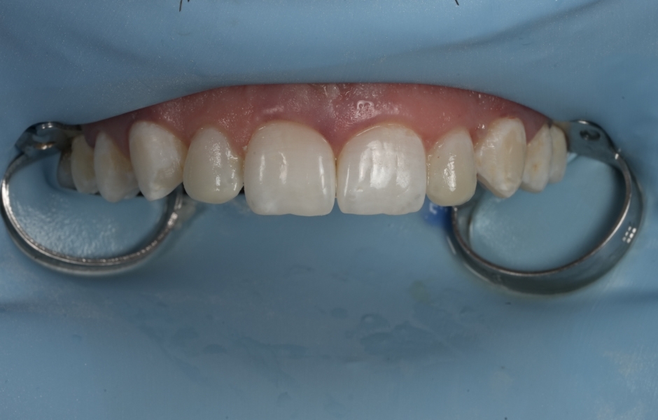 Obr. 6d: Úsměv bezprostředně po aplikaci kompozita (GrandioSO Unlimited A1; split-dam).