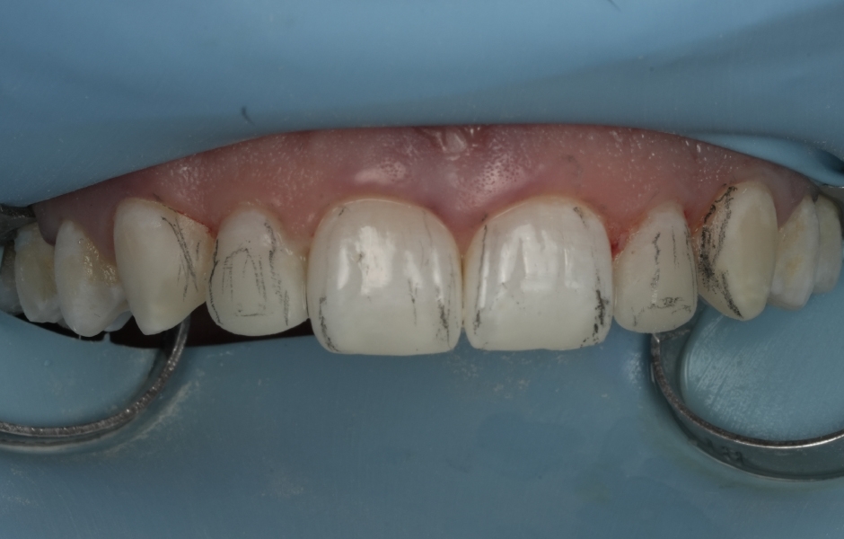 Obr. 6e: Leštění – vyznačení primární a sekundární anatomie.