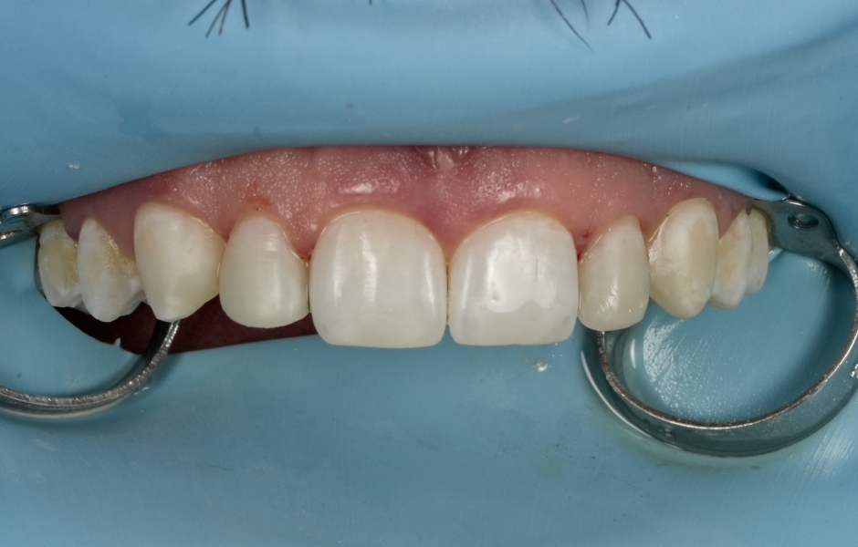 Obr. 6f: Úsměv bezprostředně po iniciálním leštění.