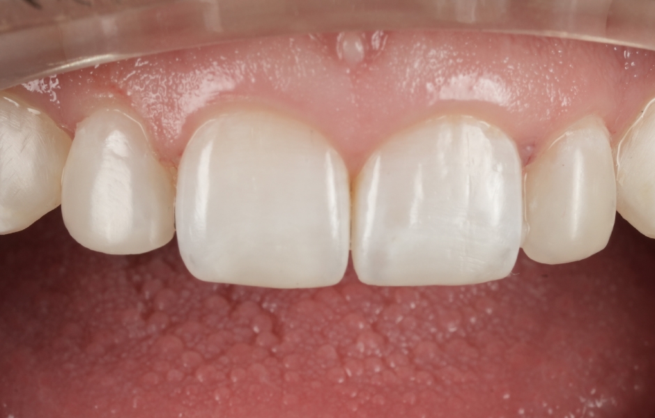 Obr. 6h: Pooperační detail při kontrolní návštěvě.