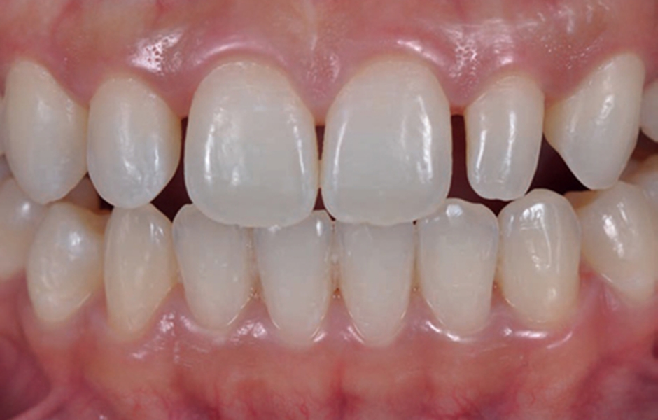Stefan Koubi – případová studie bělení zubů