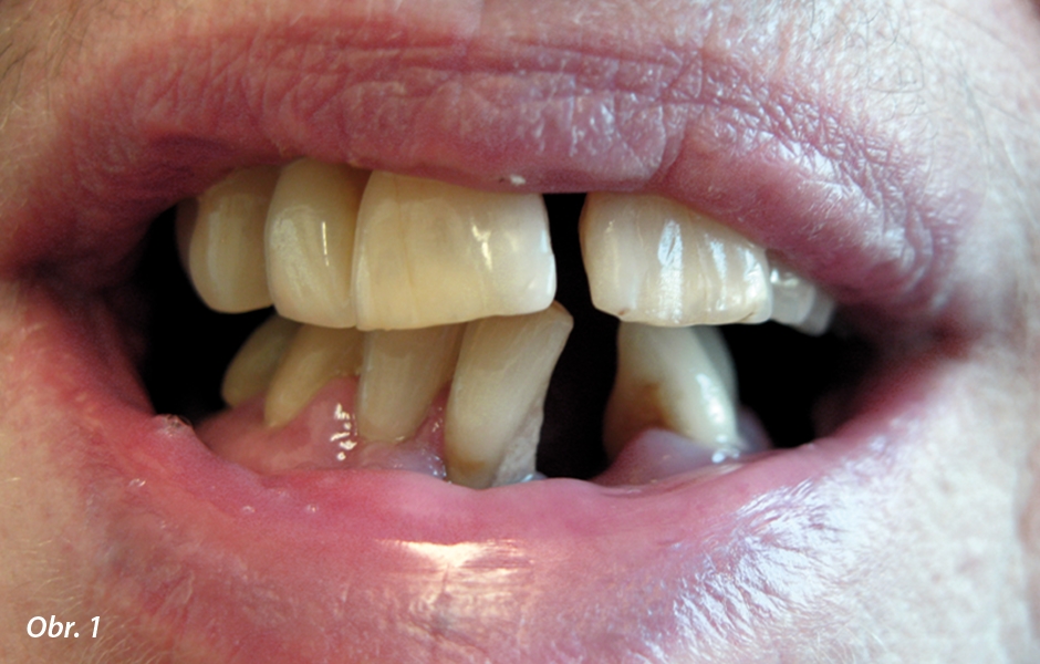 Stav (parodontóza) v ústech paní Jarmily před extrakcí zubů