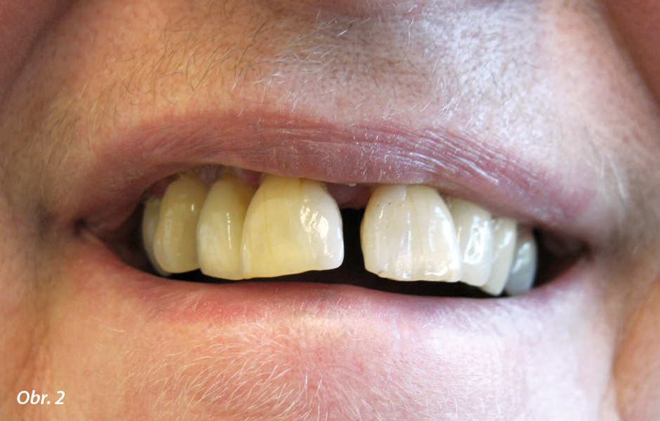 Stav (parodontóza) v ústech paní Jarmily před extrakcí zubů
