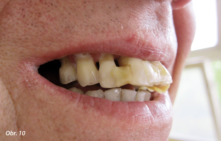 Stav (parodontóza) v ústech pana Karla před extrakcí zubů