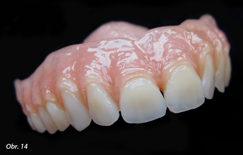 Detaily sliznice, slizničních řas, uzdiček a jiných struktur dásně, včetně mezery u krčku zubů