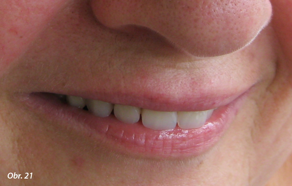 Velké řezáky při úsměvu lehce dominují – překrývají incizní část dolního rtu