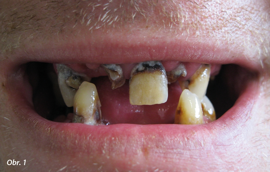 Stav v ústech pacienta před extrakcí