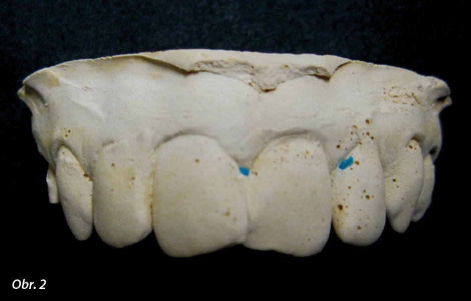 Postavení zubů podobné původnímu chrupu pacienta