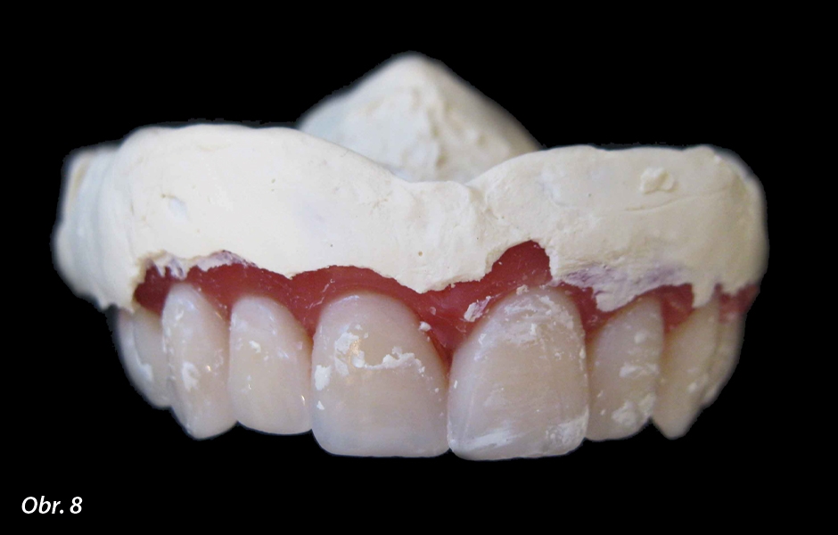 Základ báze z tepelně tvarovatelné fólie, na kterém je zkouška postavení zubů ve vosku, poslouží i jako otiskovací lžíce