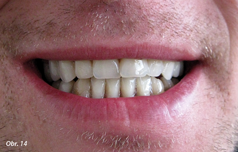 Srovnání: stav před extrakcí – zvolená předloha postavení zubů – hotové náhrady v ústech