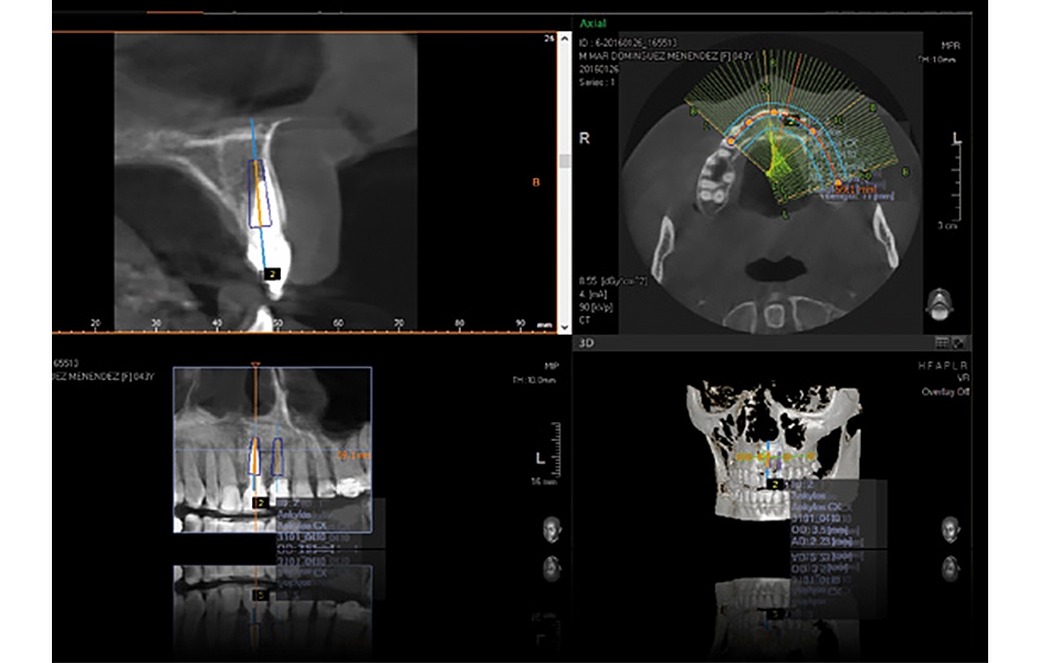 Obr. 3, 4: Předoperační rentgenový snímek.
