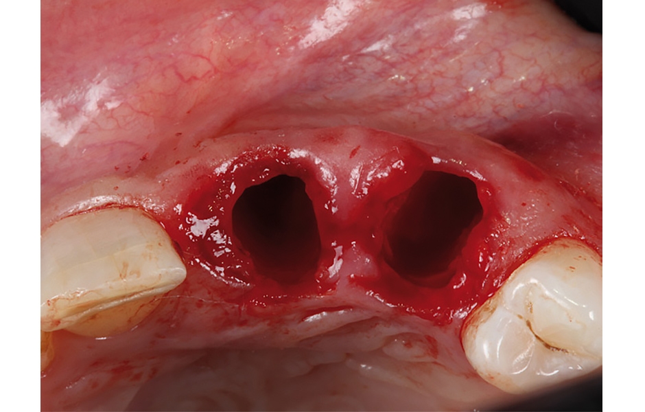 Obr. 5: Situace po extrakci frontálních zubů (vzhledem k průběhu poextrakčních ran bude nutno předejít disangulaci zavedených implantátů).
