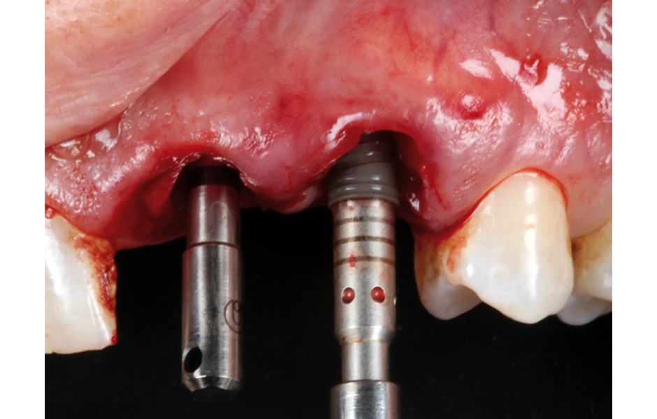 Obr. 7: Zavedení implantátů CM Drive Acqua 3.5 × 10 mm: v místě zubu 21 subkrestálně 3 mm, v místě zubu 22 subkrestálně 2 mm.