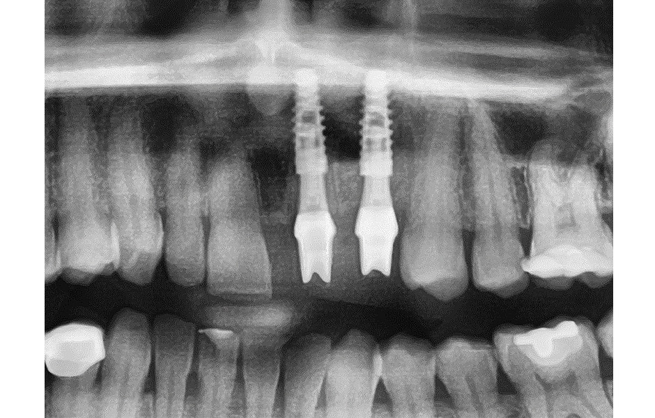 Obr. 9: RTG snímek zavedených implantátů již s individuálními abutmenty (viz dále).