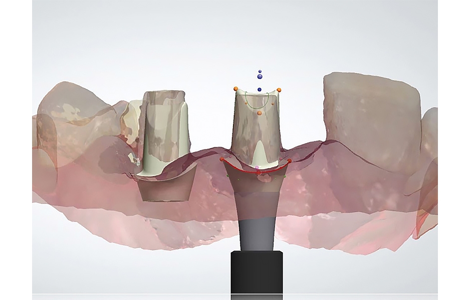 Obr. 11: CAD návrh zirkonových individuálních abutmentů.