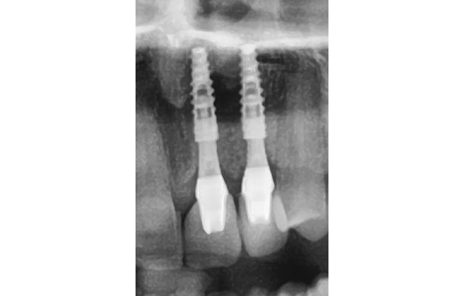 Obr. 18: Kontrolní rentgenový snímek rok po zavedení implantátů.
