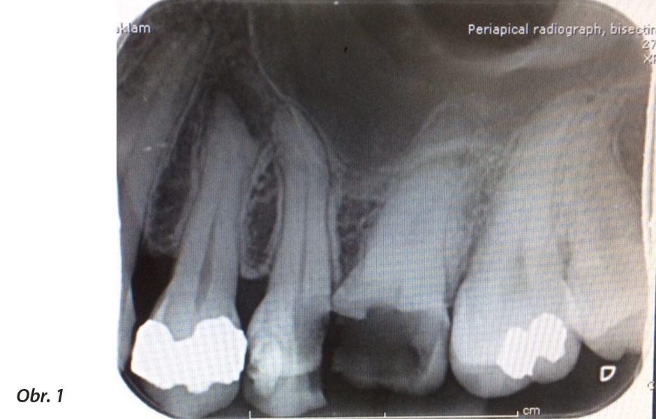 Periapikální RTG snímek zachycuje rozsáhlý kaz v zubu 26 zasahující pod úroveň alveolární kosti.