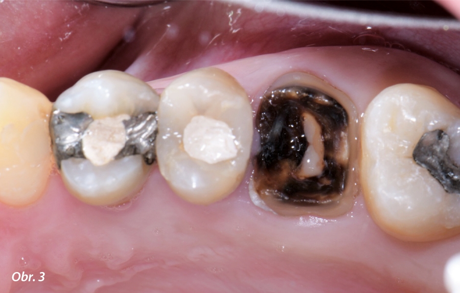 Zub 26 před extrakcí – zub byl značně zasažen zubním kazem a vzhledem k nedostatku zbývající zubní struktury jej nebylo možno rekonstruovat.