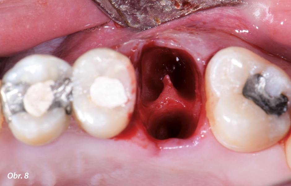 Lůžko zubu 26 po extrakci vykazuje minimální poškození přilehlé kosti a měkkých tkání.