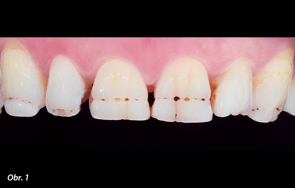 Zuby 54leté pacientky, která si přála ošetření jamek a diskolorací bez preparace