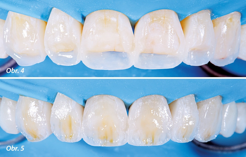Postupné dostavby palatinálních ploch s pomocí Bioclear matric a Vrstvení dentinu s dodanými pigmenty (jantarová, modrá) v incizní třetině