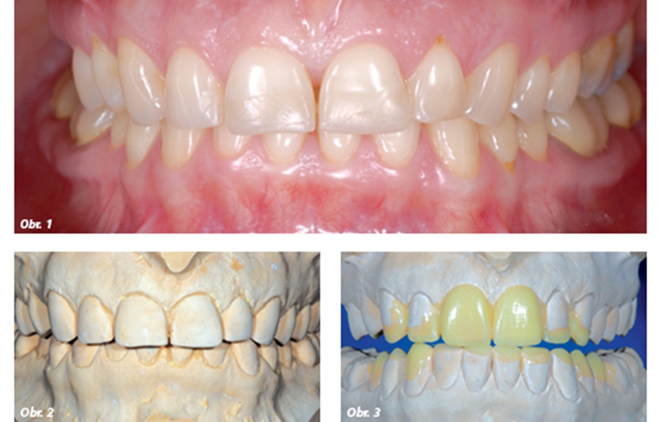 Obr. 1: Počáteční situace s esteticky narušenými náhradami, Obr. 2–3: První studijní modely a diagnostický wax-up vytvořený s částečnou pozorností věnovanou estetice a funkci