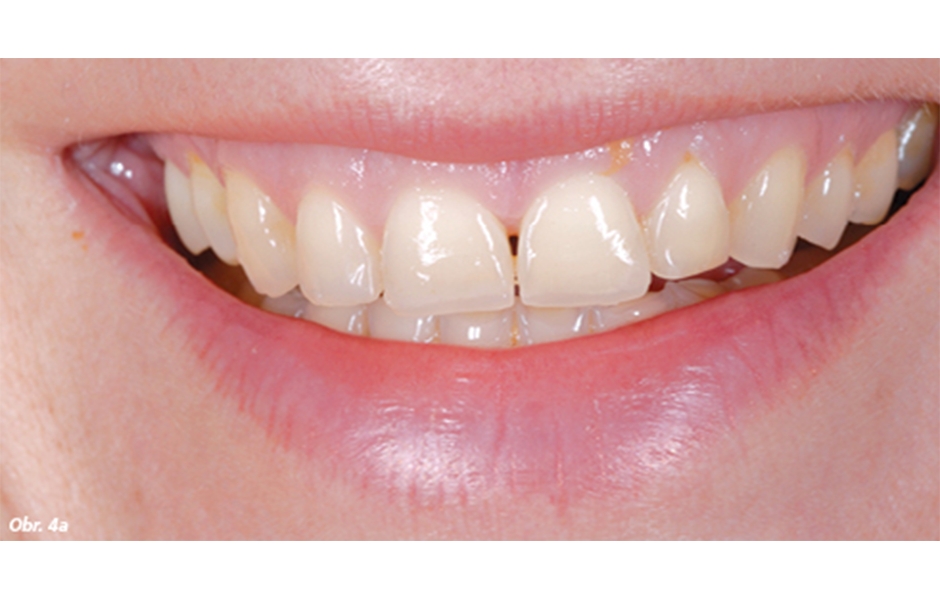 Obr. 4a, b: „PŘED A PO“ – předběžný model v dutině ústní za účelem vyhodnocení estetického vzhledu pacienta