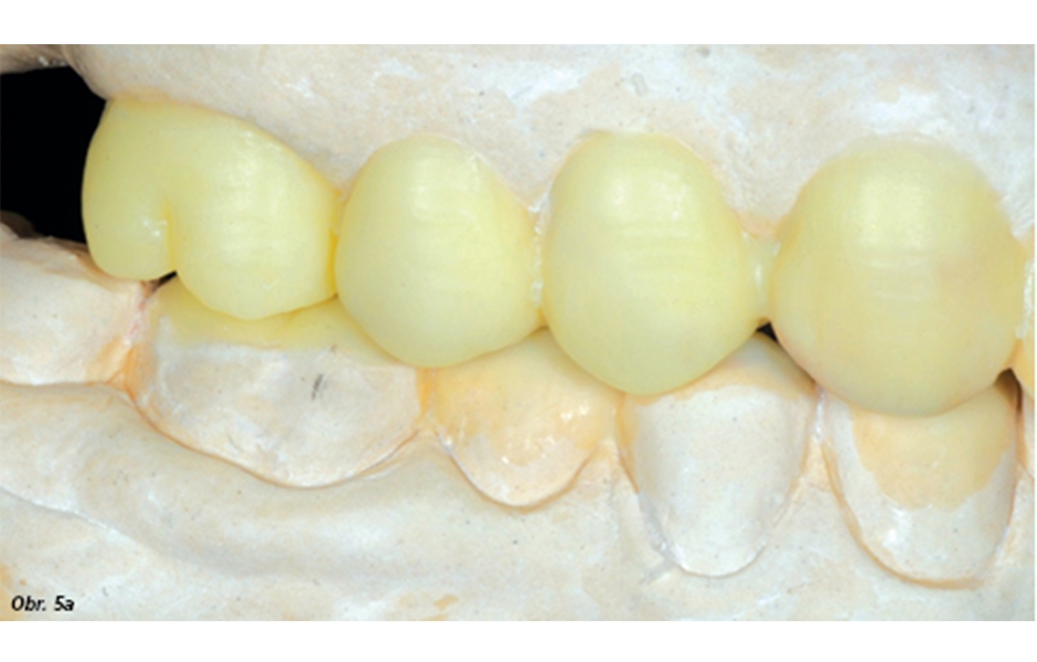 Obr. 5a–c: Definitivní wax-up vytvořený v distálních oblastech horního a dolního zubního oblouku