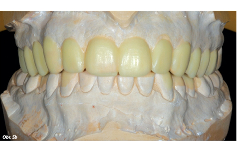 Obr. 5a–c: Definitivní wax-up vytvořený v distálních oblastech horního a dolního zubního oblouku