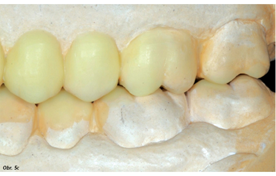 Obr. 5a–c: Definitivní wax-up vytvořený v distálních oblastech horního a dolního zubního oblouku