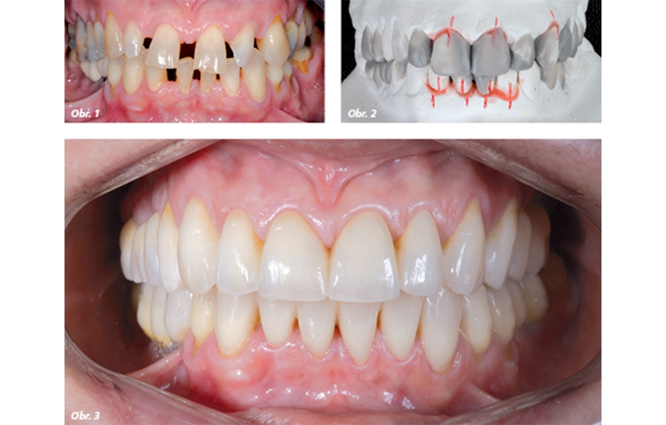 Složitý protetický případ ošetřený pomocí multidisciplinárního přístupu. Změna tvaru a zvětšení frontálních zubů, jejich ortodontický posun a harmonizace okluzních rovin byly nejprve simulovány na diagnostickém wax-upu. Tímto technickým plánem se řídilo k
