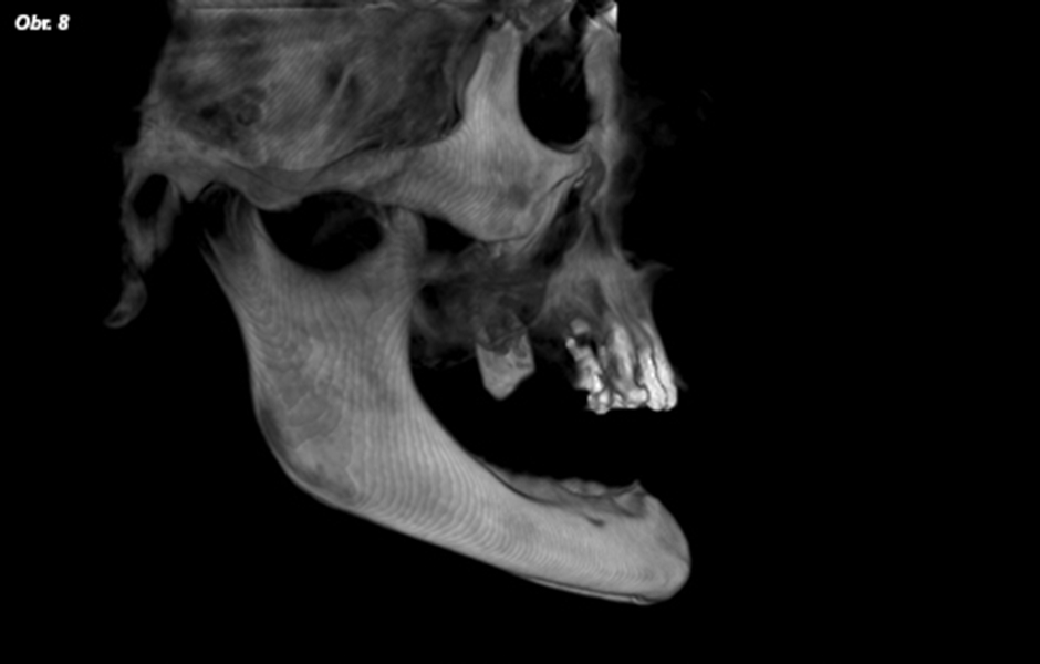 Pro tohoto pacienta byly naplánovány fixní náhrady v obou obloucích nesené implantáty. Po extrakci zbylých zubů v horním oblouku následovalo okamžité zavedení a zatížení implantátů v obou obloucích.