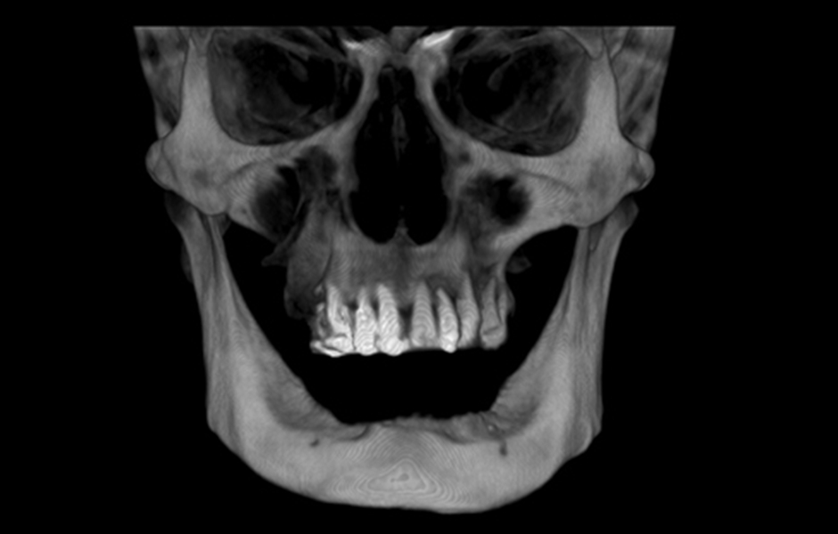 Pro tohoto pacienta byly naplánovány fixní náhrady v obou obloucích nesené implantáty. Po extrakci zbylých zubů v horním oblouku následovalo okamžité zavedení a zatížení implantátů v obou obloucích.